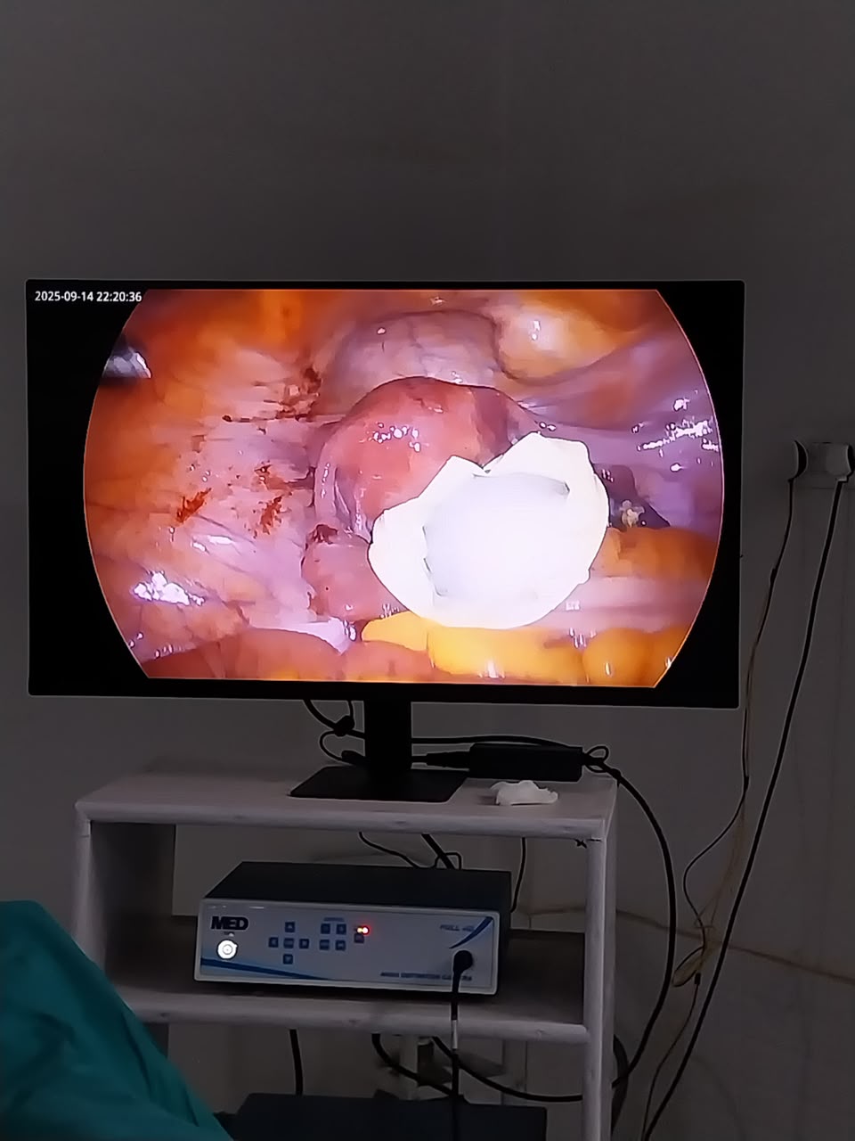 Laparoscopy view 1